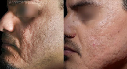 Sérum de Ácido Salicílico — Piel Limpia, Sin Espinillas y Sin Imperfecciones