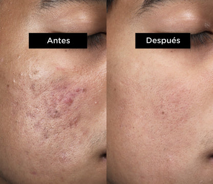 Sérum de Ácido Salicílico — Piel Limpia, Sin Espinillas y Sin Imperfecciones