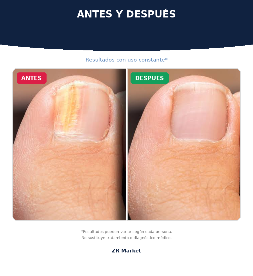 ¿HONGOS EN LAS UÑAS?
