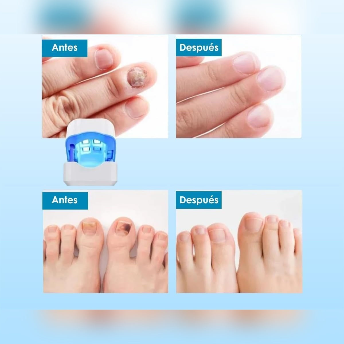 ¿HONGOS EN LAS UÑAS?