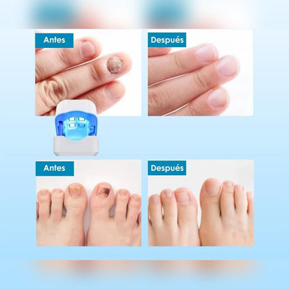 ¿HONGOS EN LAS UÑAS?